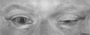 2-1 Ptosis - The upper eyelid covers part of the iris